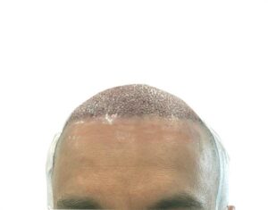 Hair Transplant Recovery Timeline: Day 1-1