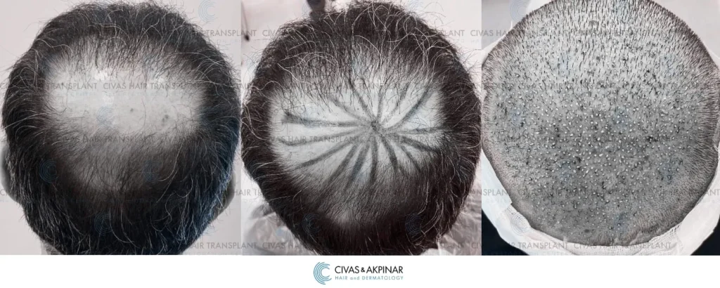Crown Hair Transplant