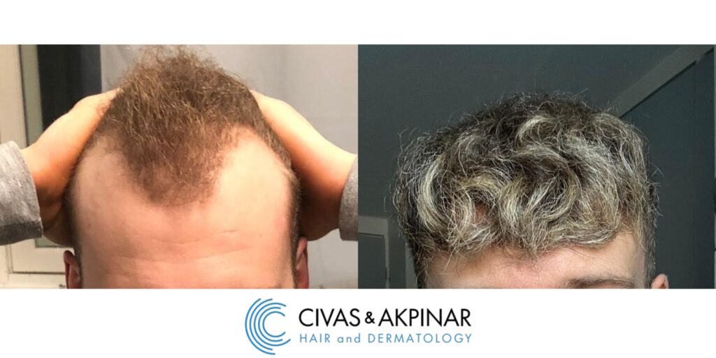 Dye hair after hair transplant: Before & After