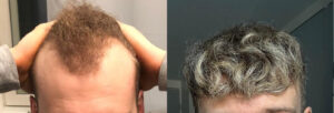 Dye hair after hair transplant: Before & After