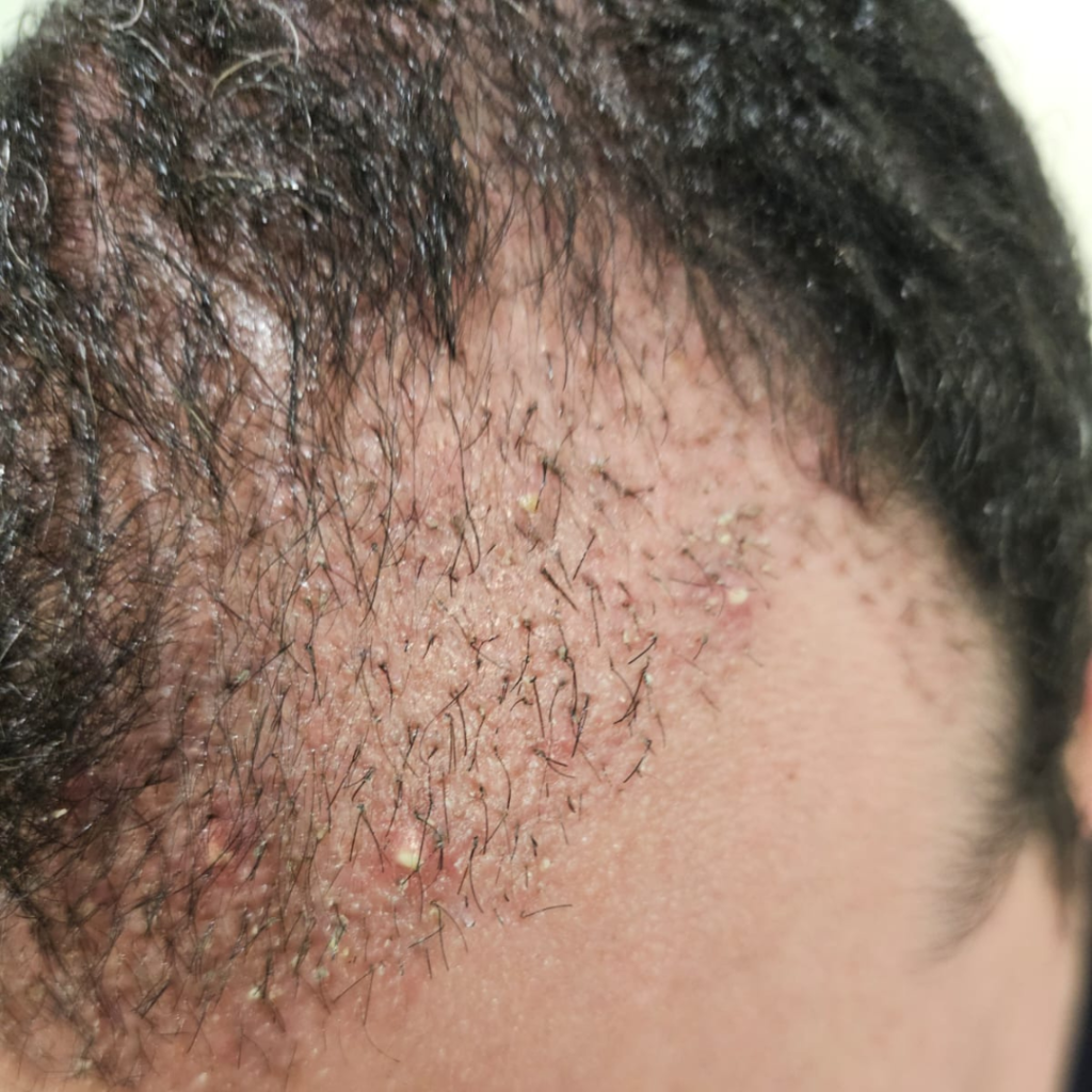Folliculitis After Hair Transplant: Patient 1
