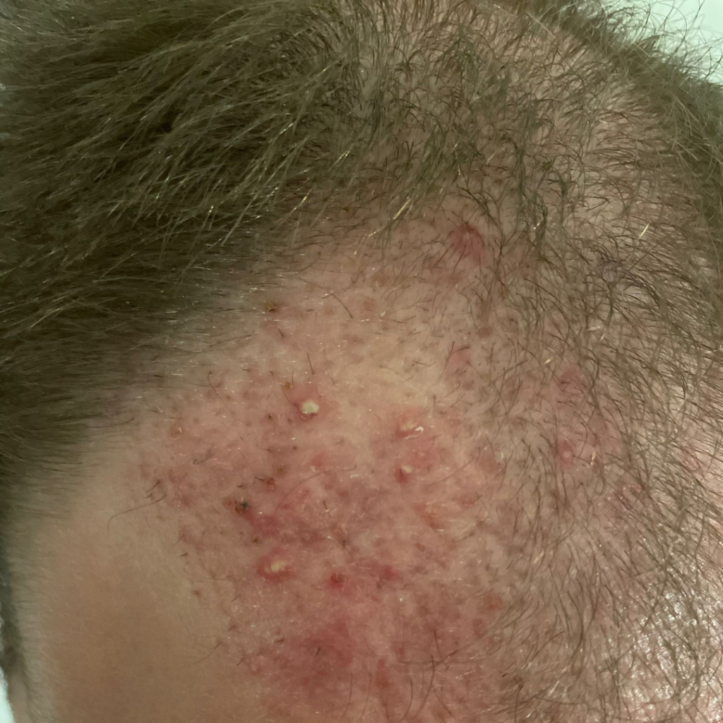 Folliculitis After Hair Transplant: Patient 2