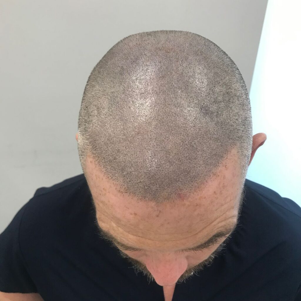 Hair Transplant and SMP