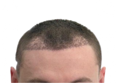 Failed Hair Transplant: Low Density, Poor Growth and Unnatural Hairline Design