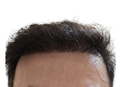 Failed Hair Transplants: Unnatural Hairline Design