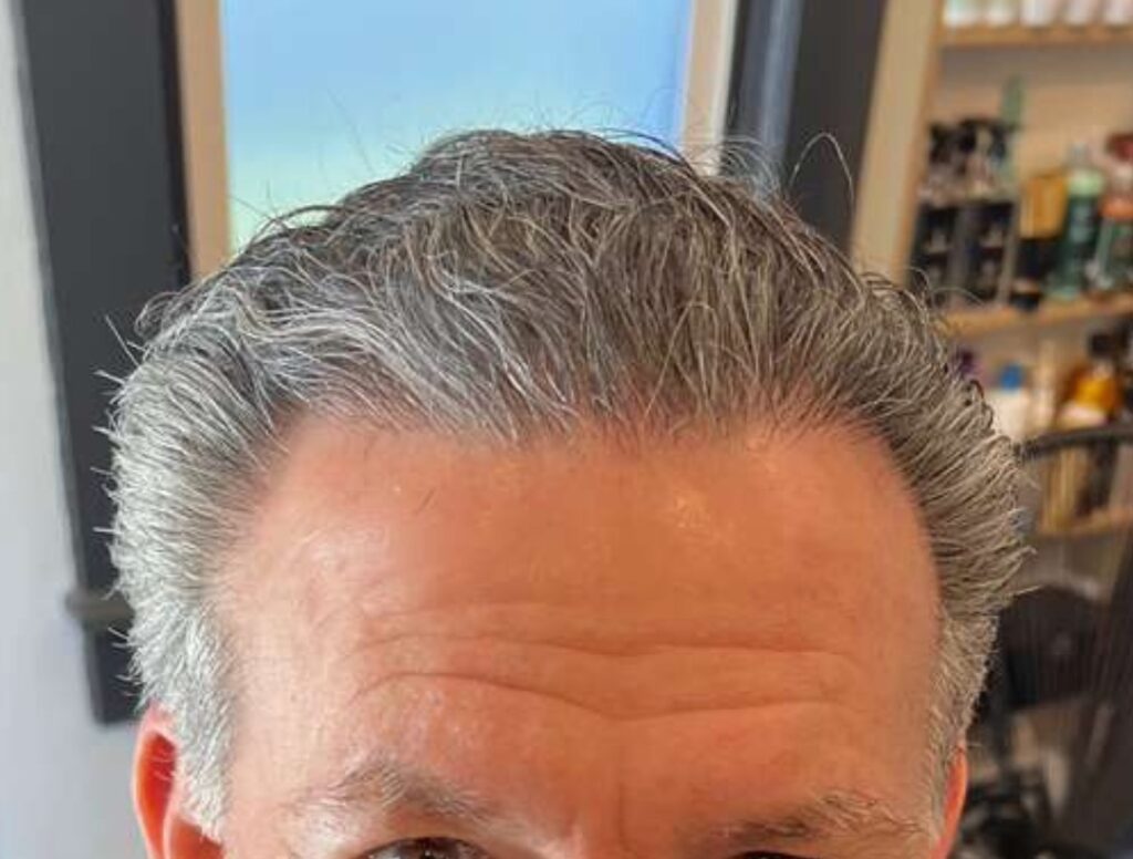 Hair Texture After Hair Transplant - Dry
