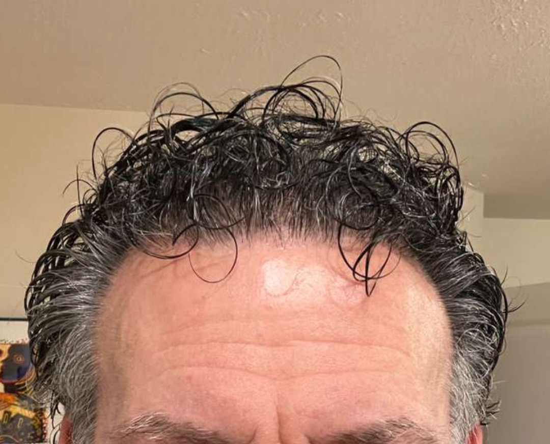 Hair Texture After Hair Transplant - Wet