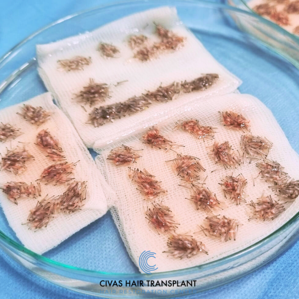 Ideal Graft Number For Hair Transplant