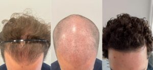 Ideal Graft Number For Hair Transplant: 3000 Grafts- Before&After