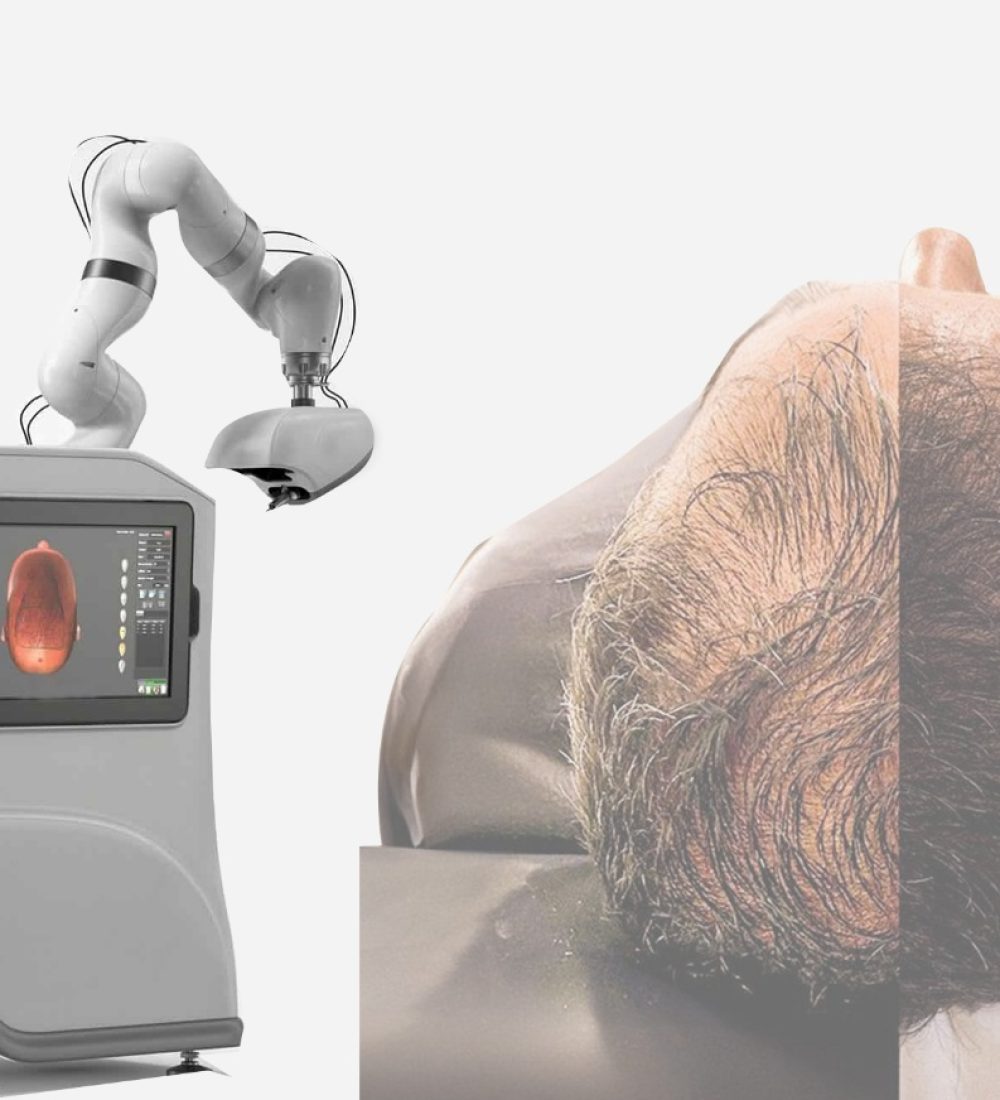 AI-Assisted Hair Transplantation