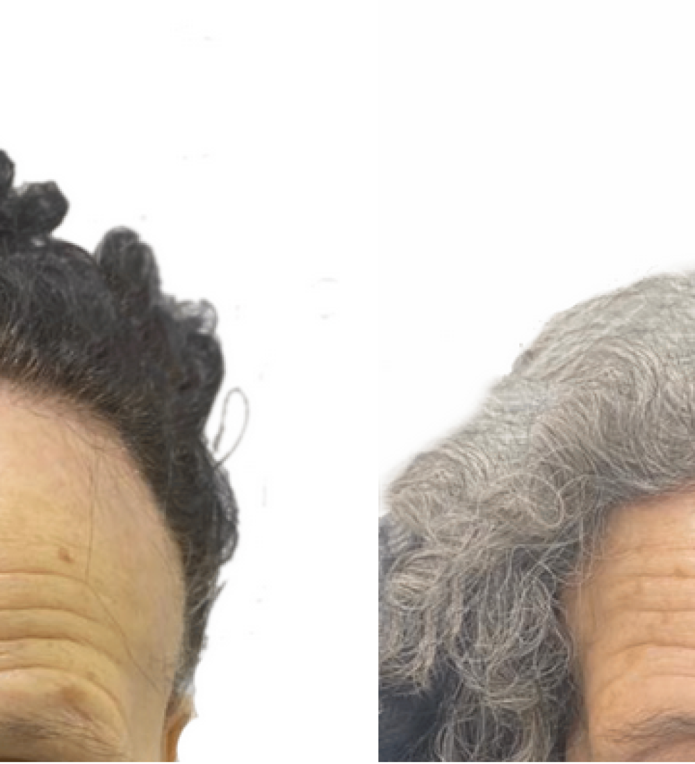 Frontal Fibrosing Alopecia