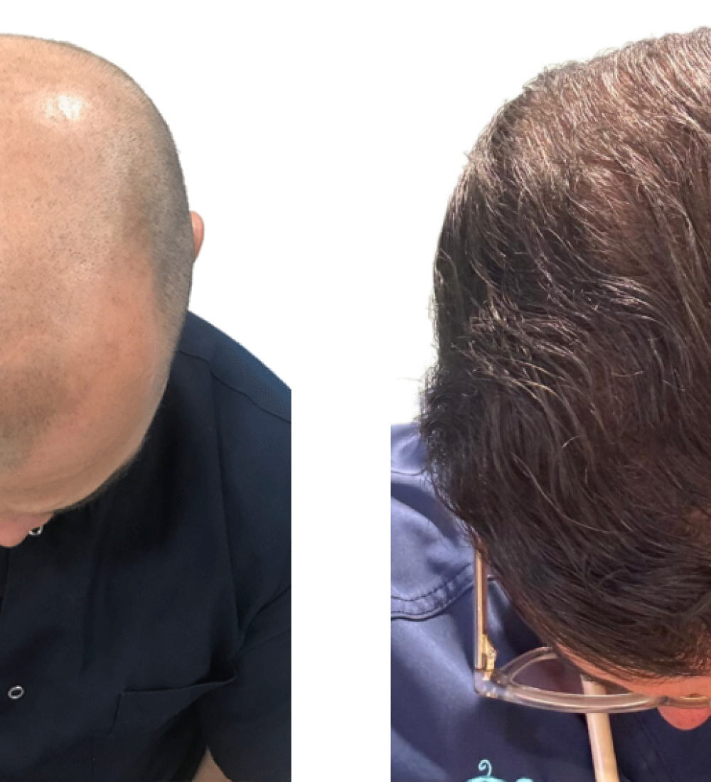 Hair Transplant Success Rate