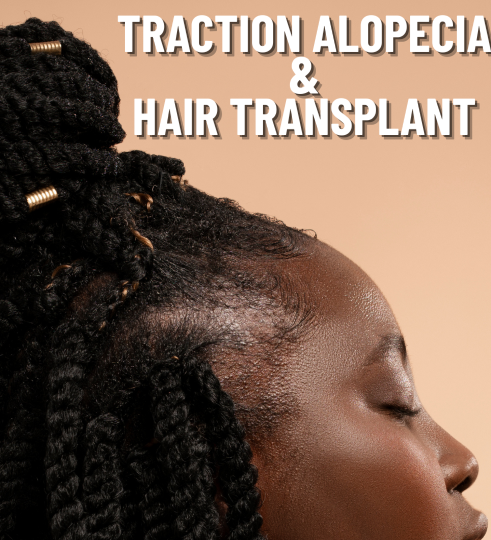 Traction Alopecia hair transplant