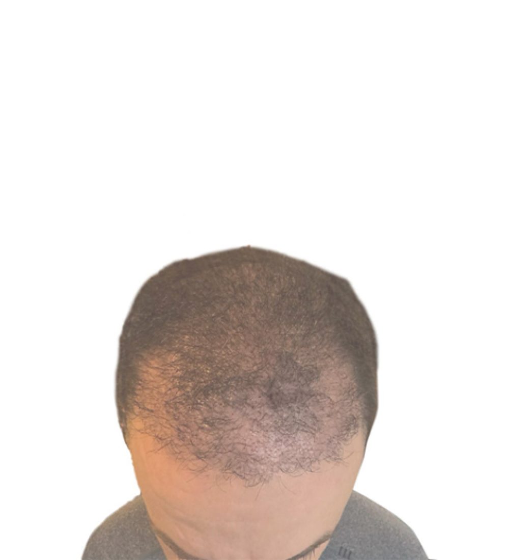 Hair Transplant Recovery Timeline