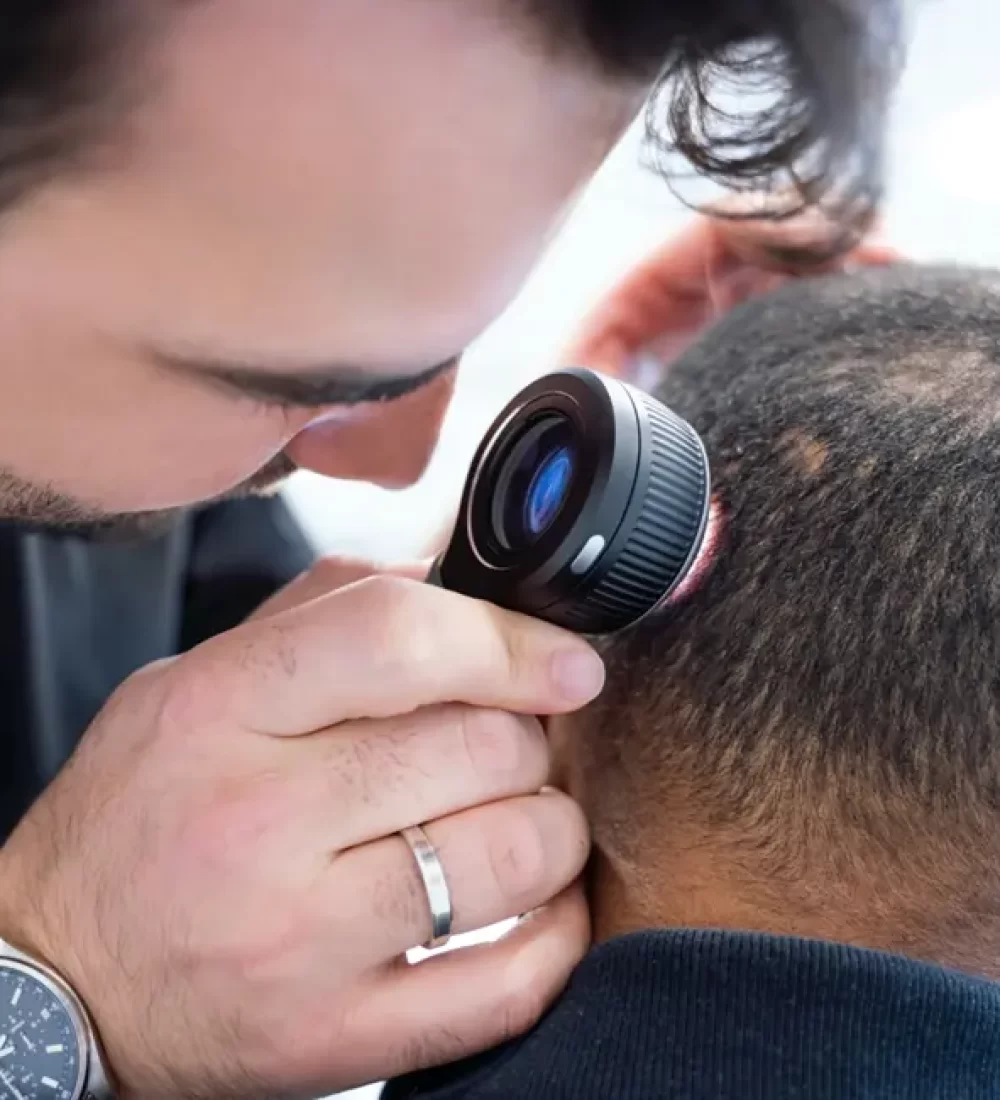 How Many Grafts Are Needed For Hair Transplant: Safe Donor Area Assessment by Hair Surgeon